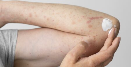 ce este psoriazisul și cum se manifestă blog Farmacia Terrapharm